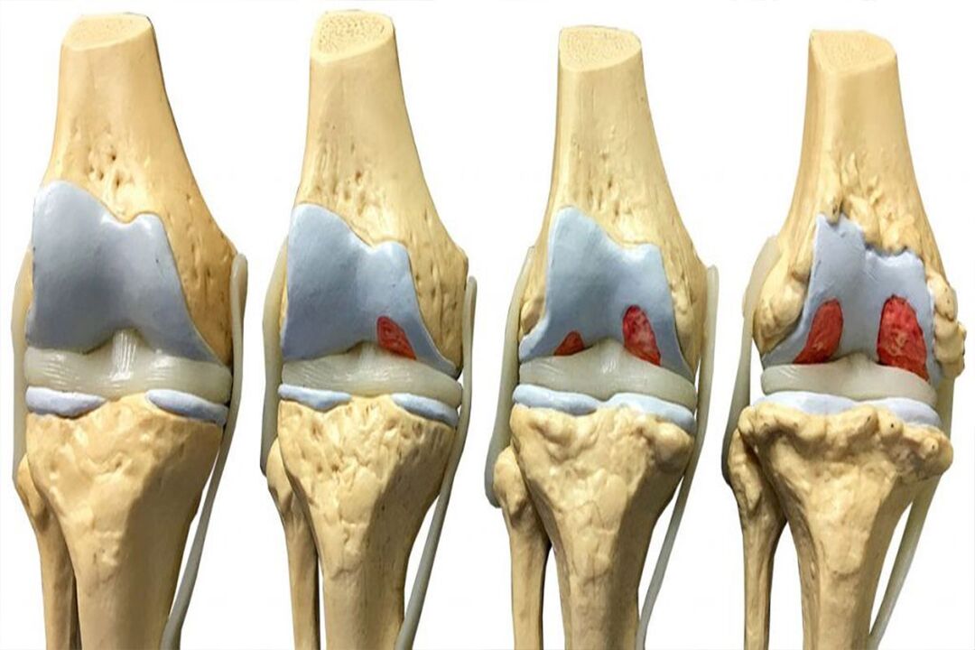 Stades de développement de l'arthrose