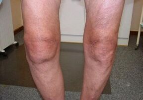 Comment traiter l'arthrose de l'articulation du genou