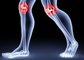 Les raisons du développement de l'arthrose du genou