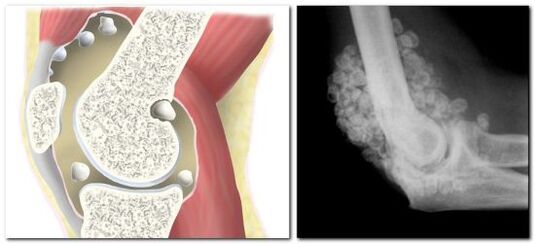 Chondromatose avec douleur à l'articulation de la hanche