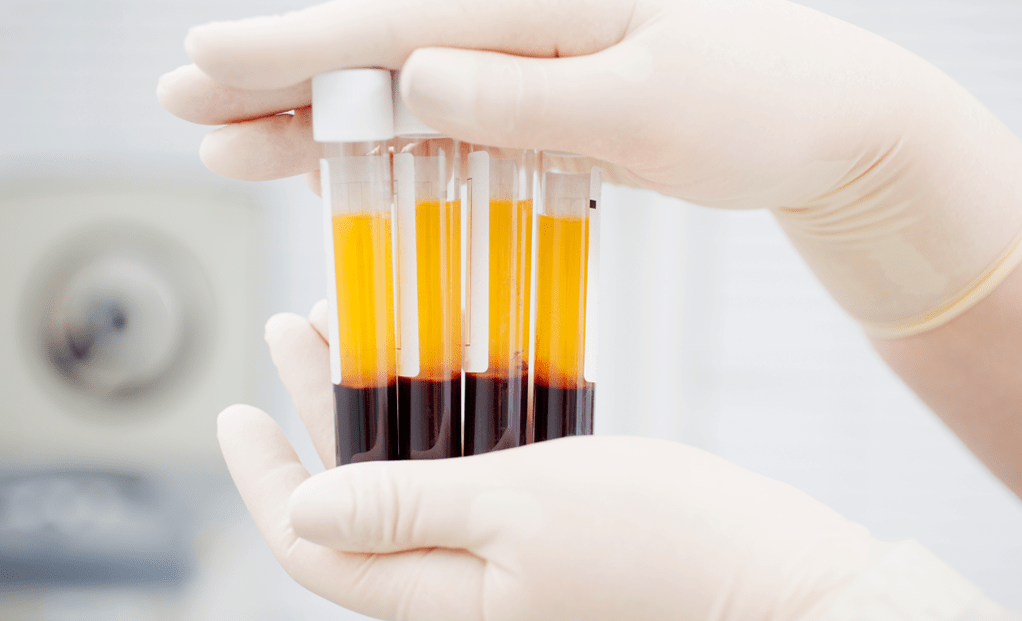 Plasma riche en plaquettes pour le traitement PRP de l'arthrose