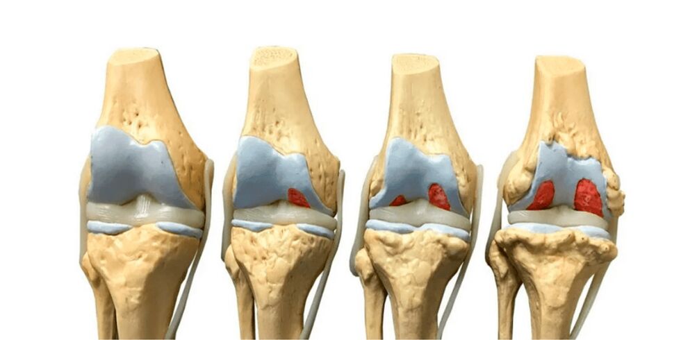 Degré d'arthrose des articulations